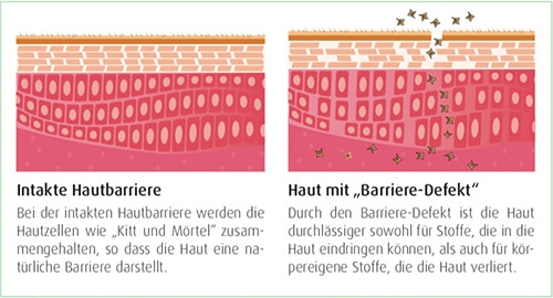 Neurodermitis Hautbarriere